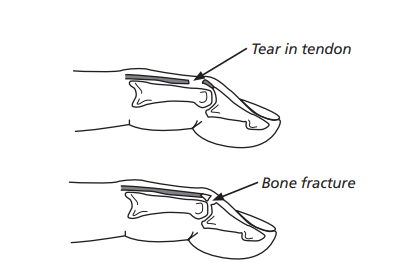 diagrams of the finger, showing the two types of mallet finger injury, tear in tendon, and bone fracture