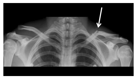 X-ray showing a clavicle fracture
