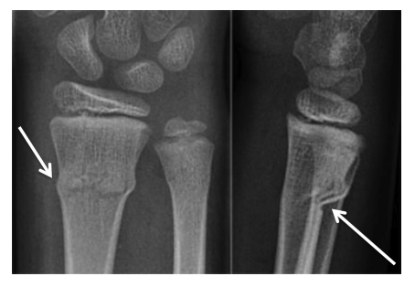 X-ray showing a buckle fracture
