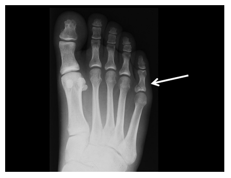 X-ray of a foot showing a toe fracture