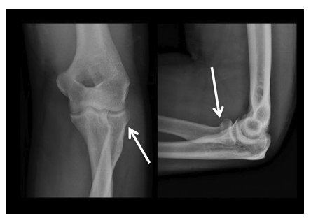 X-ray showing an elbow fracture