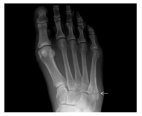X-ray of a foot with a fifth metatarsal base fracture