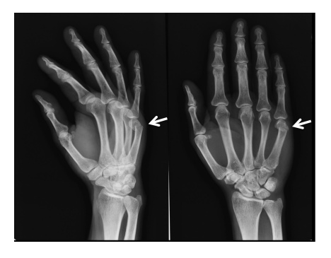 X-ray of a hand with a fifth metacarpal neck fracture