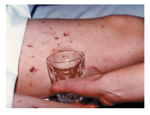 photograph of the tumbler test on a non-blanching rash
